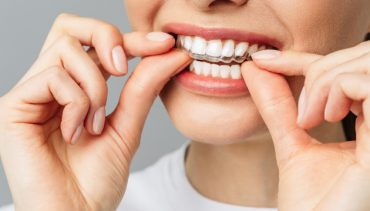 Benefits of Aligners
