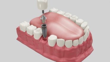 પ્રભાવશાળી ઉંમરનું પ્રથમ પગથિયું ડેન્ટલ ઈમ્પલાન્ટ્સ