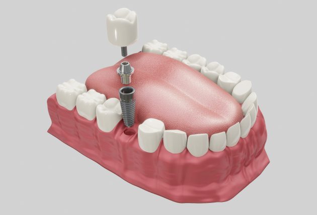 પ્રભાવશાળી ઉંમરનું પ્રથમ પગથિયું ડેન્ટલ ઈમ્પલાન્ટ્સ
