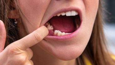 Dental Implant for Missing Teeth