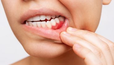 Gum treatment for Periodontitis/Pyorrhoea