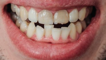 Clear Aligners – The Best Way to Correct Uneven /Crooked Teeth