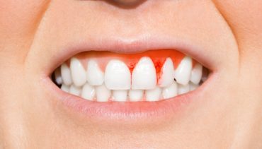 7 Reasons behind Bleeding Gums You Need to Know
