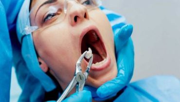 Do’s and Don’ts after Tooth Extraction