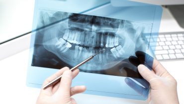 Why Do You Need Dental X-RAY?