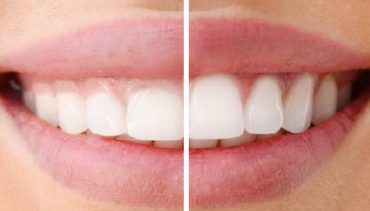Get a Shapelier Smile with Gum Line Contouring