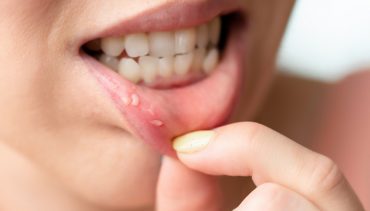 Best home remedies for mouth ulcers that give instant relief