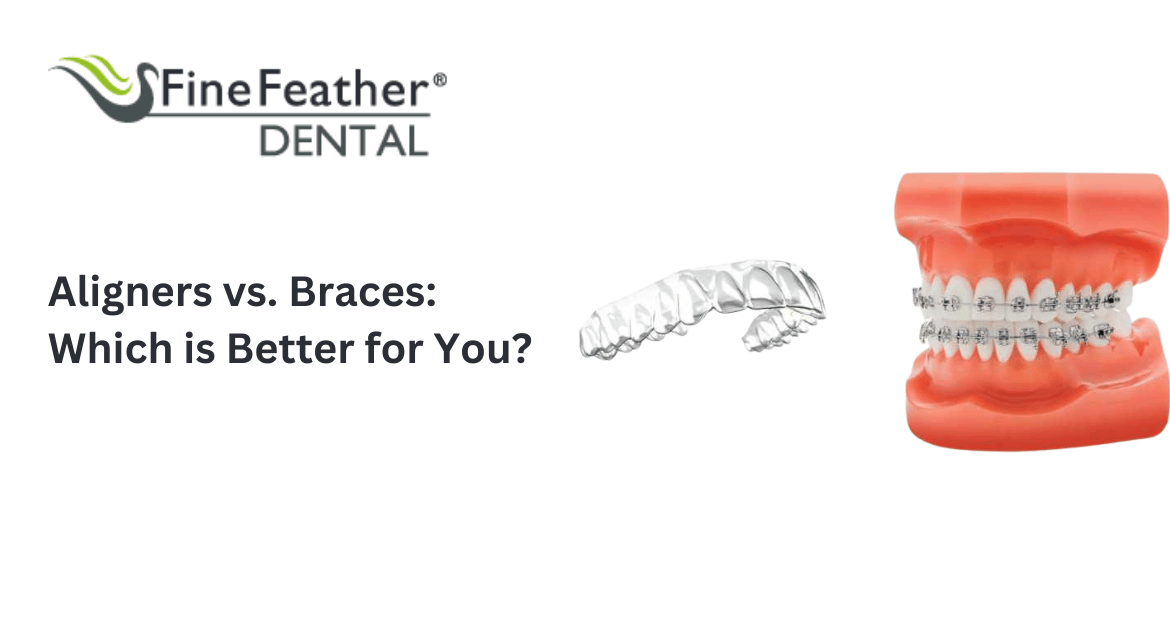 Aligners vs. Braces : Which is Better for You?