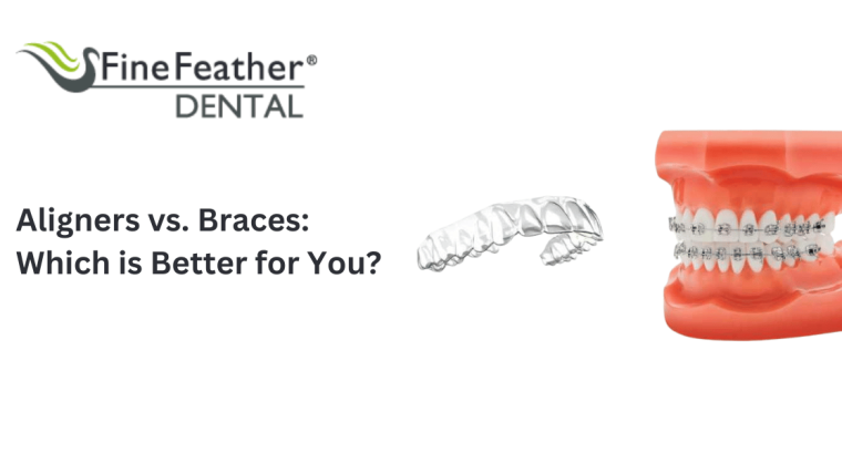 Aligners vs. Braces : Which is Better for You?