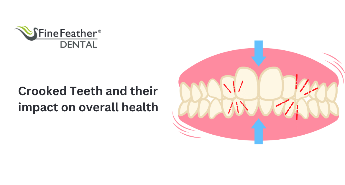 Crooked Teeth and Their Impact On Overall Health