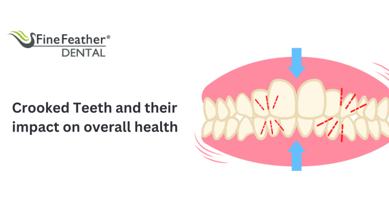 Crooked Teeth and Their Impact On Overall Health