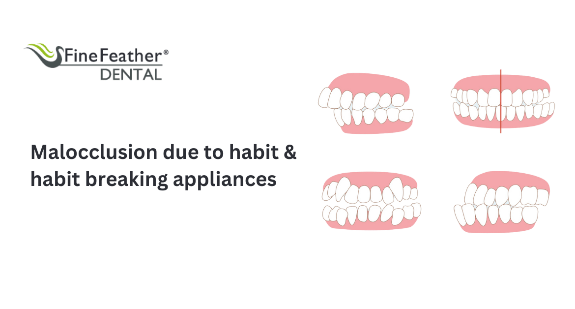 Malocclusion Due to Habit and Habit Breaking Appliances