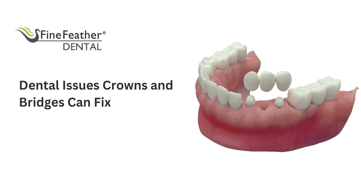 Dental Issues Crowns and Bridges Can Fix