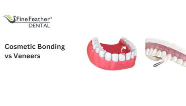 Cosmetic Bonding vs Veneers: Which Is Right for Your Perfect Smile?