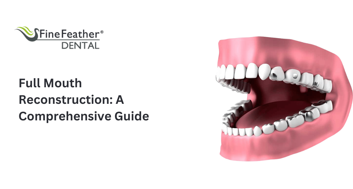 Full Mouth Reconstruction: A Comprehensive Guide