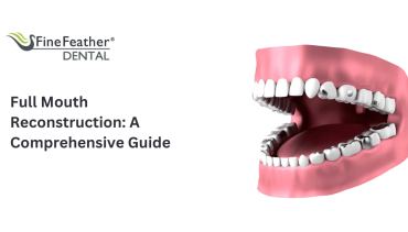 Full Mouth Reconstruction: A Comprehensive Guide