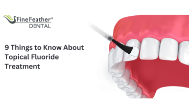 9 Things to Know About Topical Fluoride Treatment